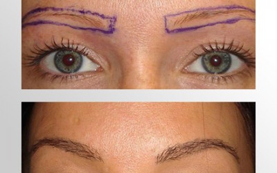 Transplante de sobrancelhas devolve a harmonia do rosto