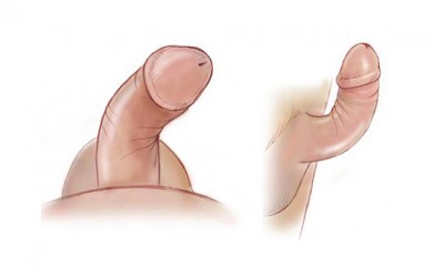 Tratamento inovador para disfunção erétil inclui cirurgia e fisioterapia